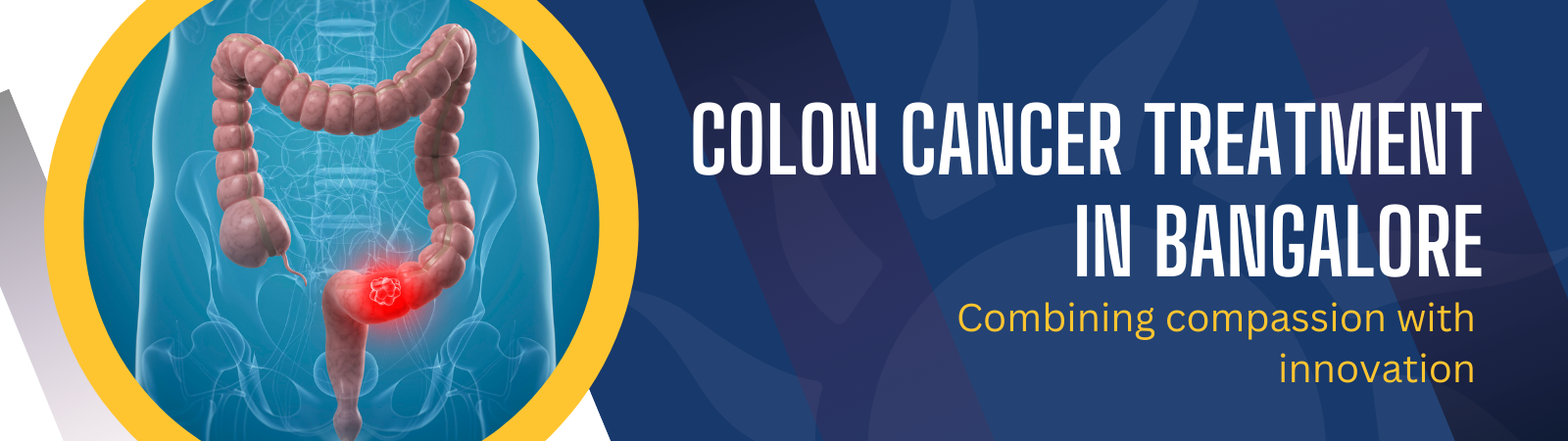 Colon Cancer Treatment Banner